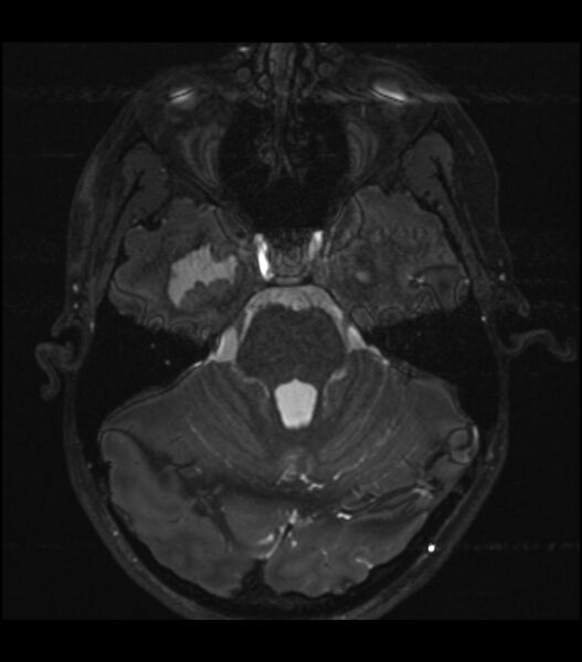 File:Choroid plexus carcinoma (Radiopaedia 91013-108553 Axial T2 CISS 1).jpg
