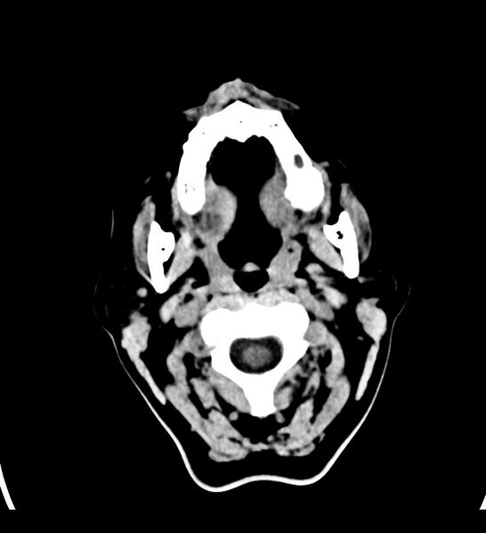 File:Choroid plexus xanthogranuloma (Radiopaedia 91271-108874 Axial non-contrast 1).jpg
