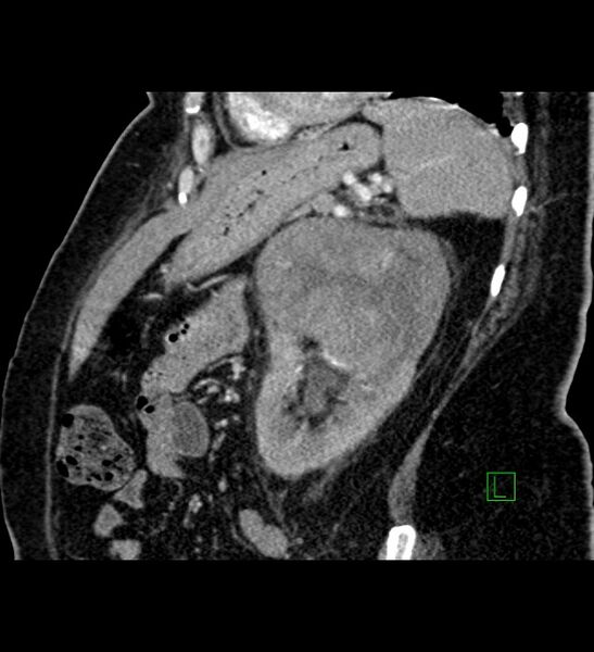 File:Chromophobe renal cell carcinoma (Radiopaedia 84239-99519 D 37).jpg