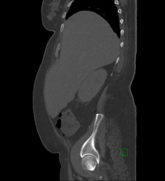 File:Chromophobe renal cell carcinoma (Radiopaedia 84239-99519 Sagittal bone window 84).jpg