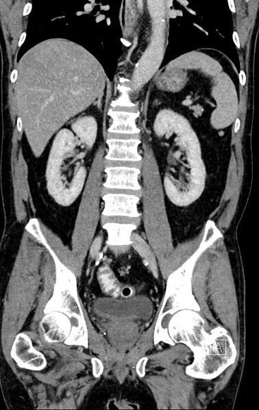 File:Chronic appendicitis complicated by appendicular abscess, pylephlebitis and liver abscess (Radiopaedia 54483-60700 C 51).jpg