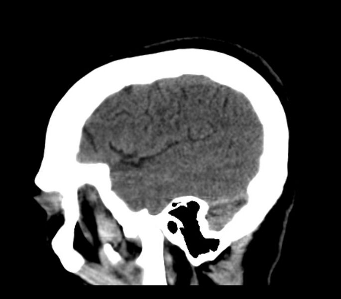 File:Chronic bilateral occipital lobe infarcts (Radiopaedia 31276-31996 C 9).jpg