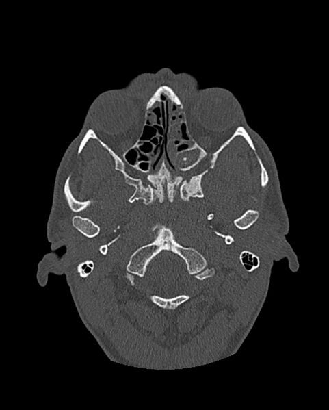 File:Chronic maxillary sinusitis caused by a foreign body (Radiopaedia 58521-65676 Axial bone window 183).jpg