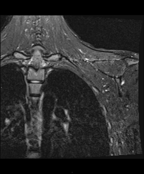 File:Chronic reactive multifocal osteomyelitis (CRMO) - clavicle (Radiopaedia 56406-63114 Coronal STIR 3).jpg