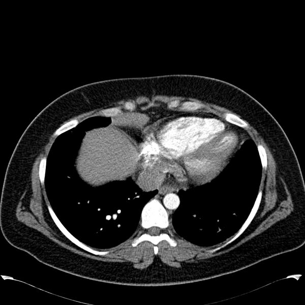 File:Chronic thromboembolic pulmonary hypertension (CTEPH) (Radiopaedia 74597-85531 Axial C+ CTPA 38).jpg