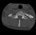 Clay-shoveler fracture (Radiopaedia 22568-22590 Axial bone window 66).jpg