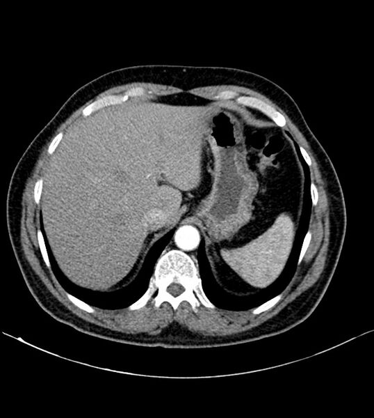 File:Clear cell renal cell carcinoma (Radiopaedia 85006-100539 B 21).jpg