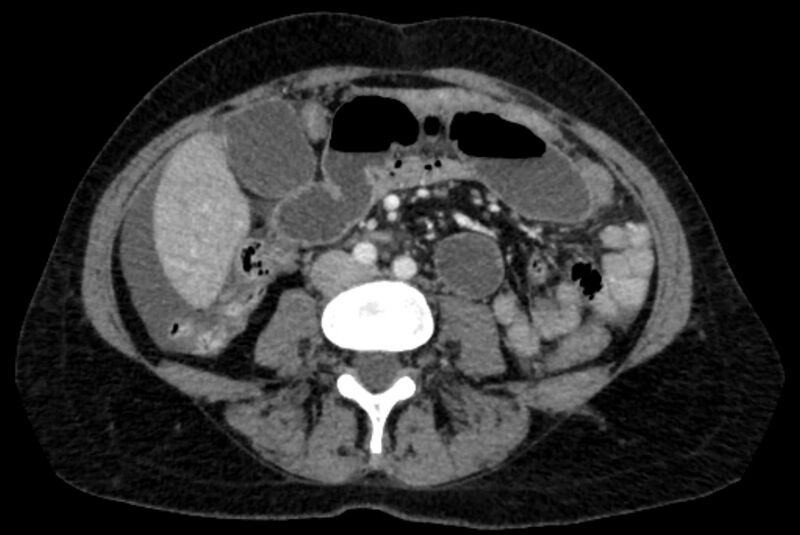 File:Closed loop small bowel obstruction (Radiopaedia 71211-81508 A 68).jpg