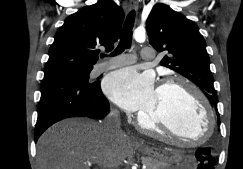 File:Coarctation of aorta with aortic valve stenosis (Radiopaedia 70463-80574 C 121).jpg