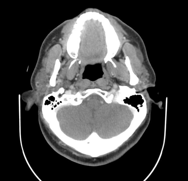 File:Colloid cyst of thyroid (Radiopaedia 22897-22923 Axial C+ delayed 16).jpg