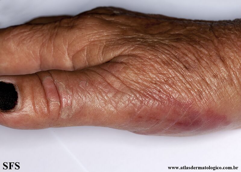 File:Erysipeloid (Dermatology Atlas 18).jpg