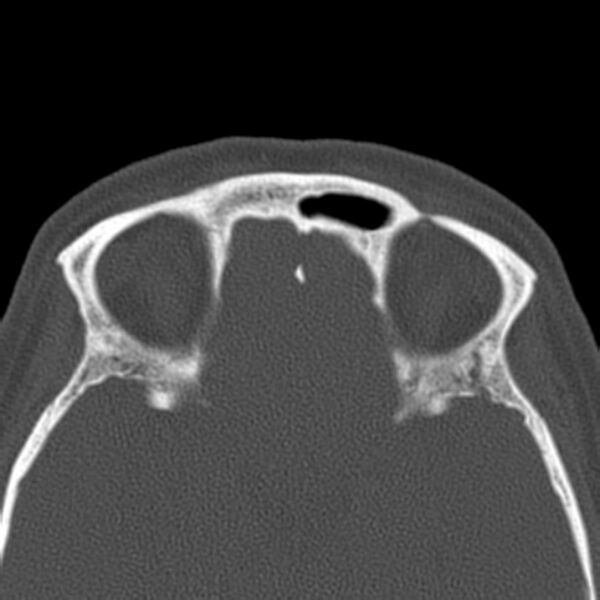 File:Nasolabial cyst (Radiopaedia 33987-35205 Axial bone window 39).jpg