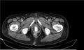Necrotizing pancreatitis (Radiopaedia 20595-20495 Axial C+ delayed 49).jpg