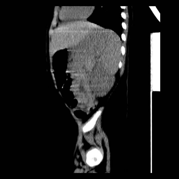 File:Neuroblastoma with skull metastases (Radiopaedia 30326-30960 B 35).jpg