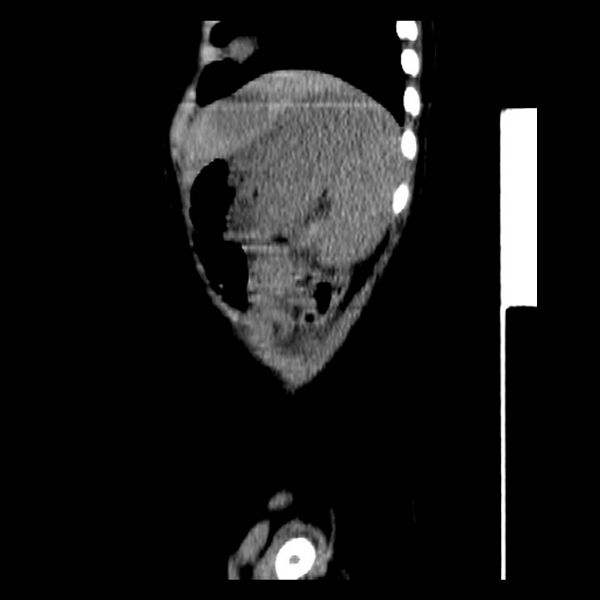 File:Neuroblastoma with skull metastases (Radiopaedia 30326-30960 B 40).jpg