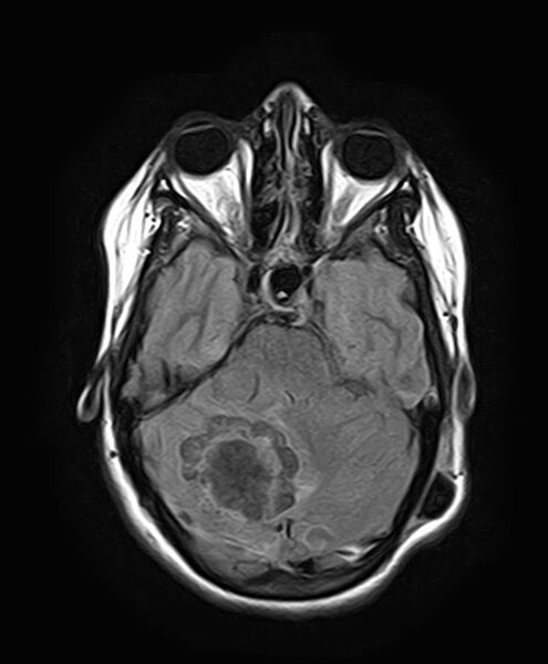 File:Neurofibromatosis type 2 (Radiopaedia 66211-75401 Axial FLAIR 12).jpg