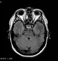 Neurosarcoidosis (Radiopaedia 10930-11351 Axial FLAIR 6).jpg