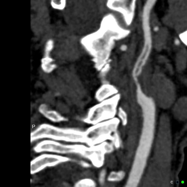 File:Non-occlusive intraluminal internal carotid artery thrombus (Radiopaedia 37751-39658 A 26).jpg