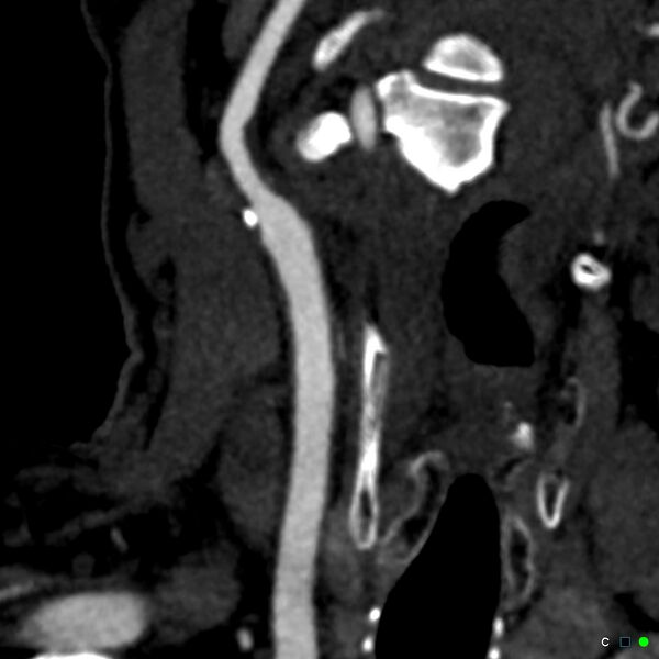 File:Non-occlusive intraluminal internal carotid artery thrombus (Radiopaedia 37751-39658 C 33).jpg