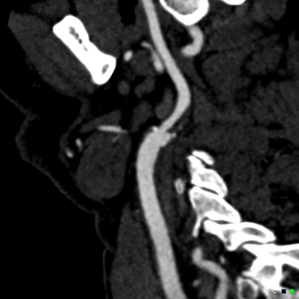 File:Non-occlusive intraluminal internal carotid artery thrombus (Radiopaedia 37751-39658 C 51).jpg