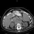 Non Hodgkin lymphoma in a patient with ankylosing spondylitis (Radiopaedia 84323-99621 Axial non-contrast 34).jpg