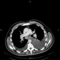 Non Hodgkin lymphoma in a patient with ankylosing spondylitis (Radiopaedia 84323-99621 B 16).jpg