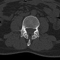 Normal CT lumbar spine (Radiopaedia 53981-60118 Axial bone window 43).jpg