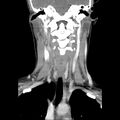 Normal CT of the neck (Radiopaedia 14575-14500 Coronal C+ 30).jpg