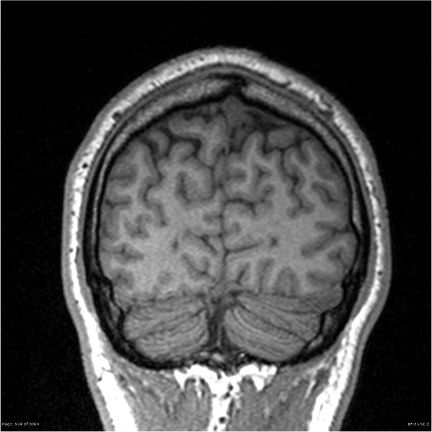 Normal brain MRI (non-focal epilepsy protocol) (Radiopaedia 38571-40700 Coronal T1 18).jpg