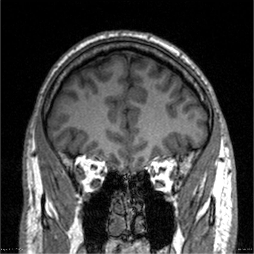 Normal brain MRI (non-focal epilepsy protocol) (Radiopaedia 38571-40700 Coronal T1 81).jpg