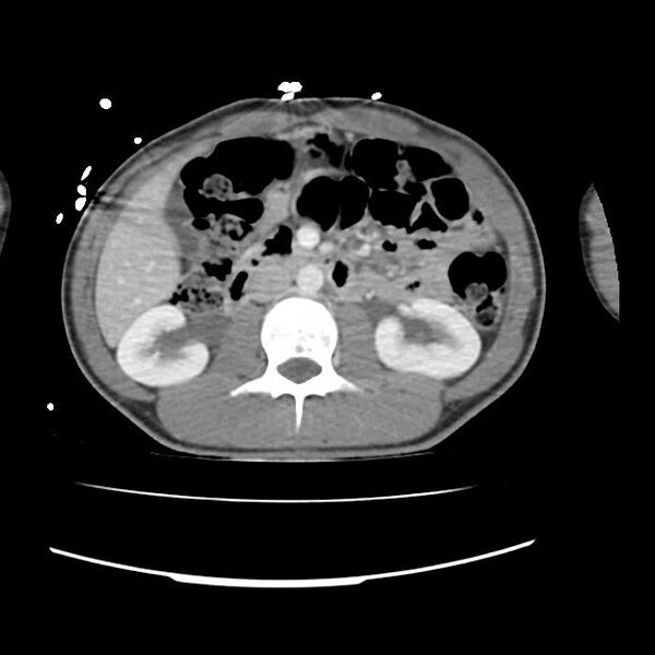 File:Normal dual-phase trauma CT chest,abdomen and pelvis (Radiopaedia 48092-52899 A 67).jpg