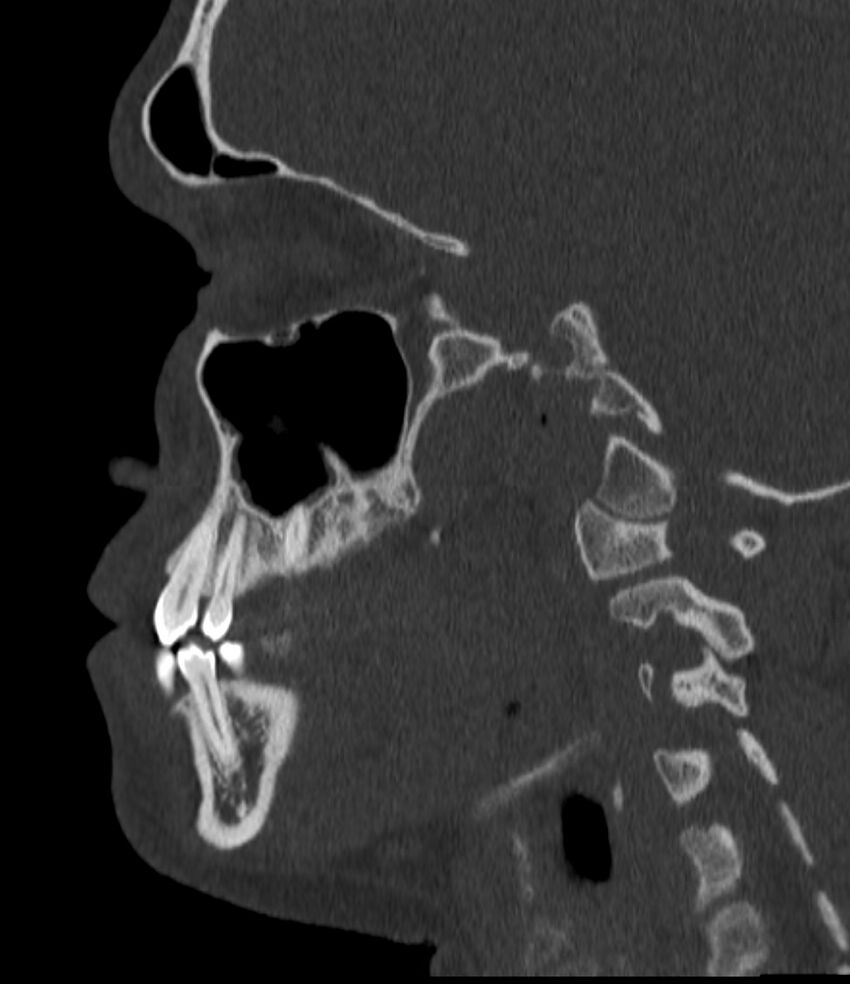 Normal facial bone CT (Radiopaedia 88742-105476 Sagittal bone window 104).jpg