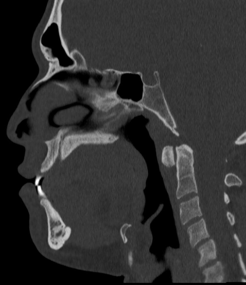Normal facial bone CT (Radiopaedia 88742-105476 Sagittal bone window 87).jpg