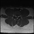 Normal lumbar spine MRI (Radiopaedia 47857-52609 Axial T1 16).jpg