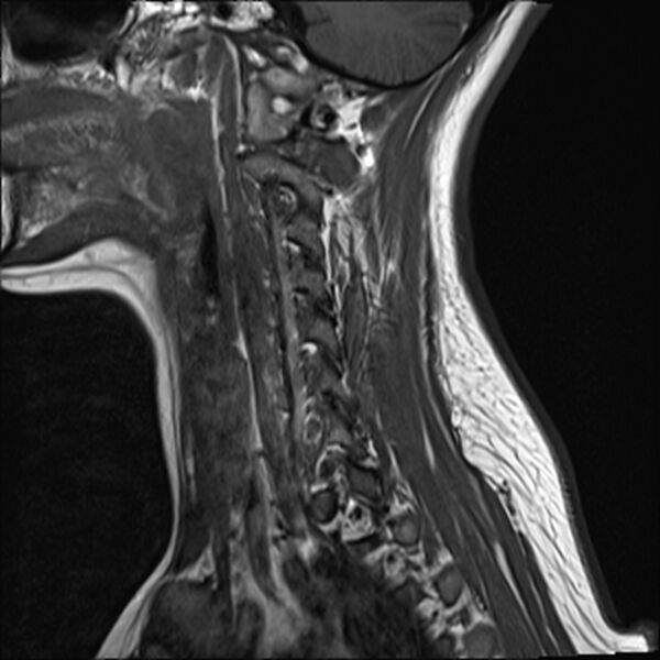 File:Normal trauma cervical spine MRI (Radiopaedia 32130-33071 Sagittal T1 2).jpg