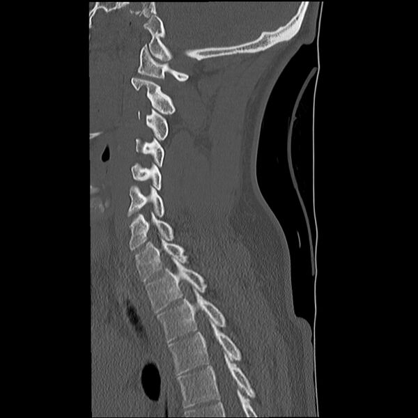 File:Normal trauma spine imaging (Radiopaedia 31753-32686 Sagittal bone window 27).jpg