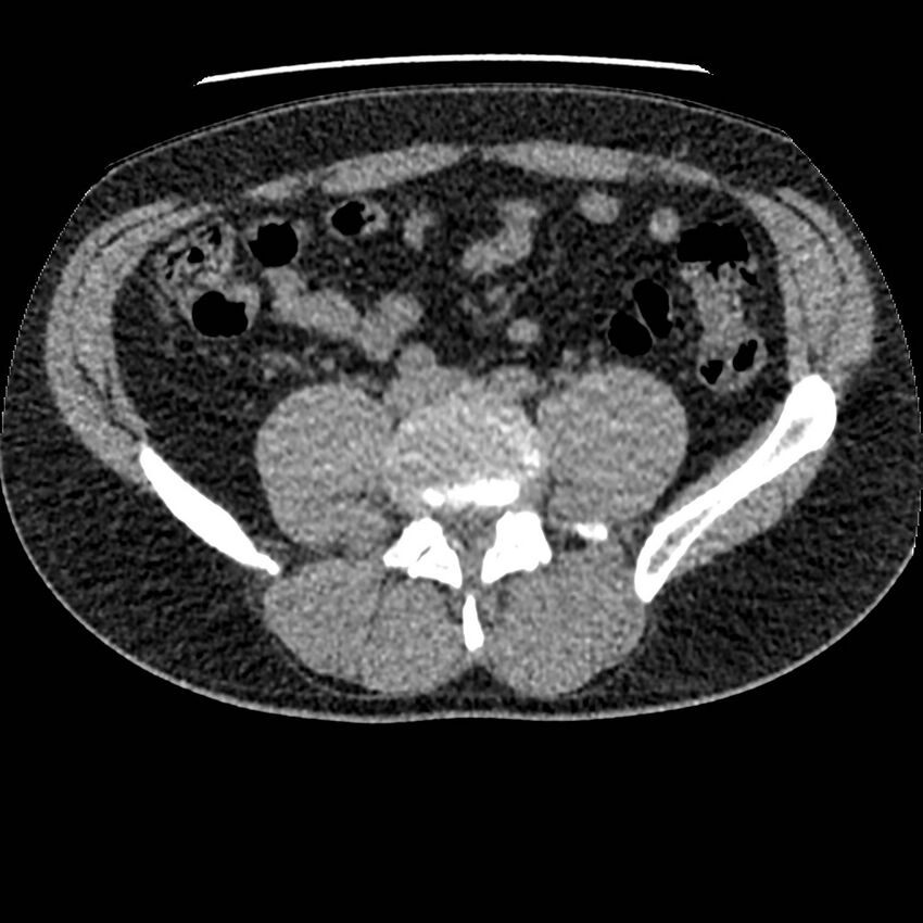 Obstructing ureteric calculus and ureteric anatomy (Radiopaedia 62730-71042 Axial non-contrast 94).jpg