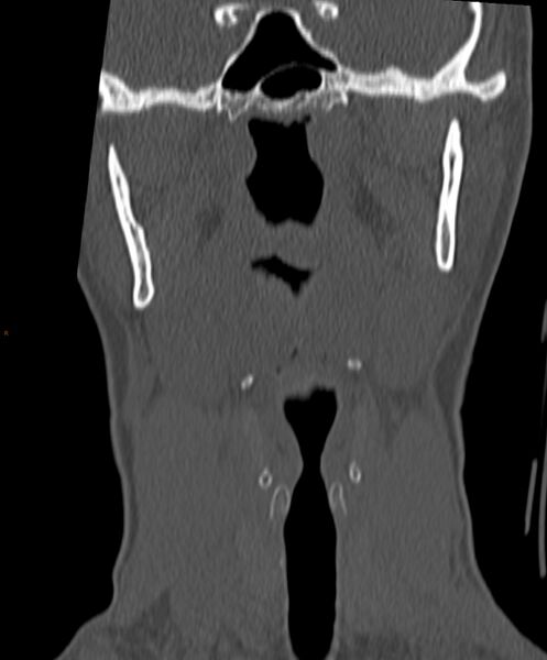 File:Occipital condyle fracture (Radiopaedia 61165-69056 Coronal bone window 17).jpg