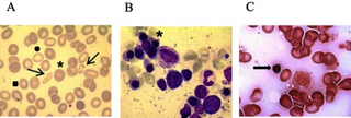 a) Peripheral blood smear shows anisopoikilocytosis (arrows), microcytosis (square), hypochromia (circle) b-c) Bone marrow smears shows erythroid hyperplasia (asterisk) ringed sideroblasts (arrow)
