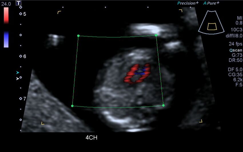 1st trimester nuchal-morphology ultrasound (Radiopaedia 44706-48477 Heart views cine with colour 1).jpg