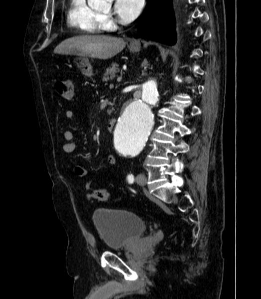 File:Abdominal aortic aneurysm (Radiopaedia 25855-26001 Sagittal C+ arterial phase 33).jpg