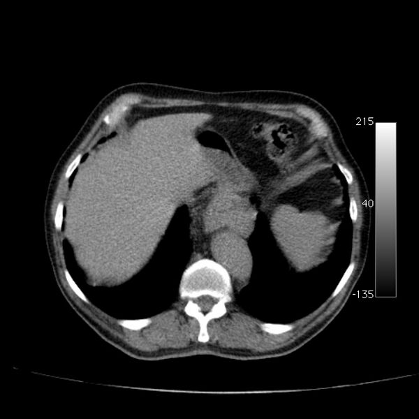 File:Abdominal aortic aneurysm (Radiopaedia 29248-29660 Axial non-contrast 11).jpg