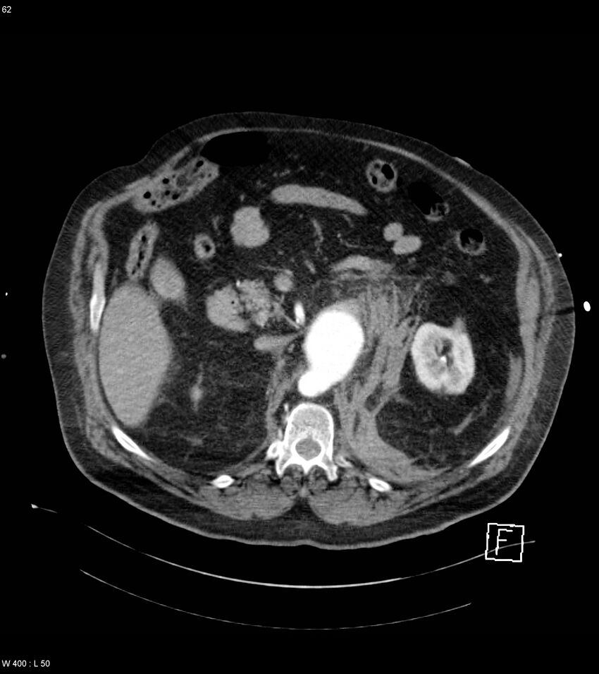Abdominal aortic aneurysm with intramural hematoma then rupture (Radiopaedia 50278-55632 Axial C+ arterial phase 61).jpg