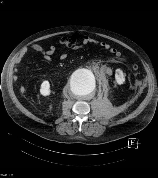 File:Abdominal aortic aneurysm with intramural hematoma then rupture (Radiopaedia 50278-55632 Axial C+ arterial phase 89).jpg