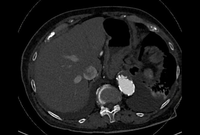 File:Abdominal aortic aneurysm with thrombus fissuration (Radiopaedia 73192-83919 Axial C+ arterial phase 12).jpg