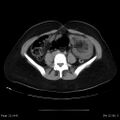 Abdominal wall endometriosis (Radiopaedia 25723-25885 Axial C+ portal venous phase 22).jpg