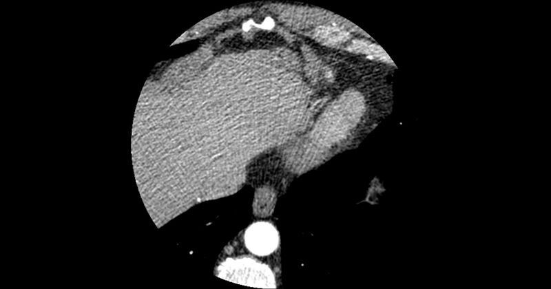 File:Aberrant left main coronary artery (ALMCA) arising from the right sinus with interarterial course (Radiopaedia 63251-71814 Axial C+ arterial phase 183).JPG