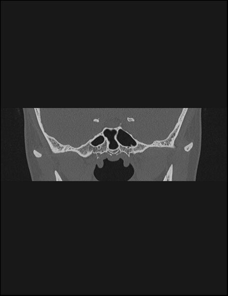File:Aberrant right internal carotid artery (Radiopaedia 65191-74198 Coronal non-contrast 3).jpg