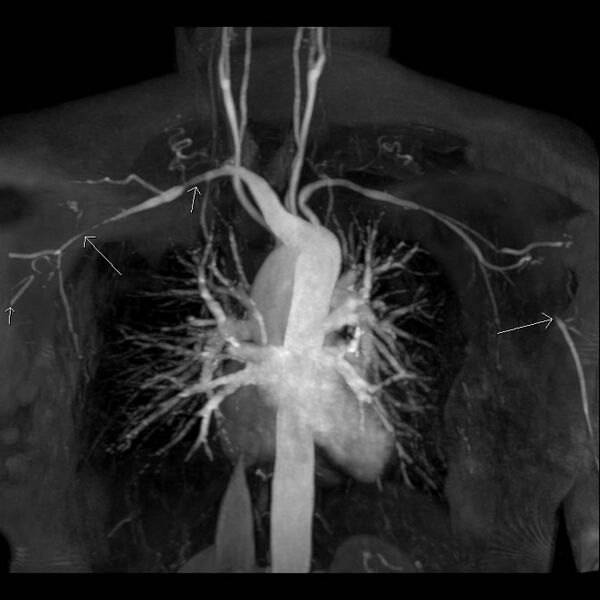 File:Aberrant right subclavian artery with background Takayasu arteritis (Radiopaedia 21423-21363 MRA 5).jpg