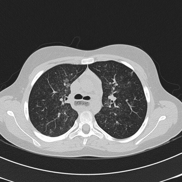 File:Achalasia (Radiopaedia 14946-14878 Axial lung window 24).jpg